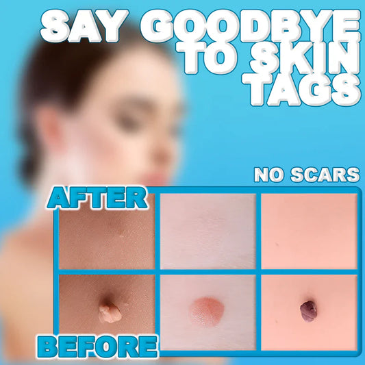 Painless Skin Tag Remover