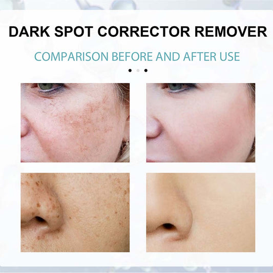 Anti-Dark Spot Skin Care Lightens Pigmentation Spots