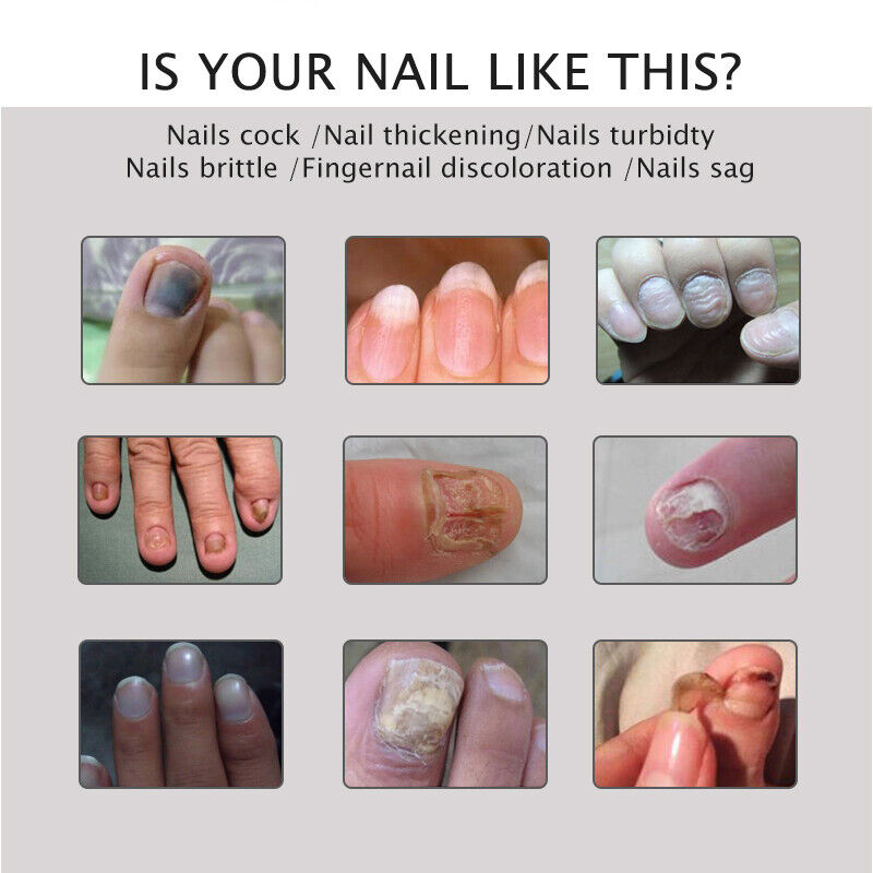 Nail Repair Treatment Gel