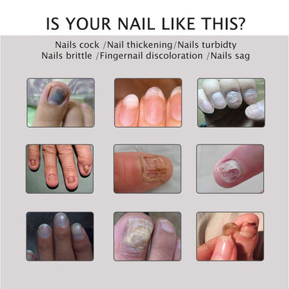 Nail Repair Treatment Gel