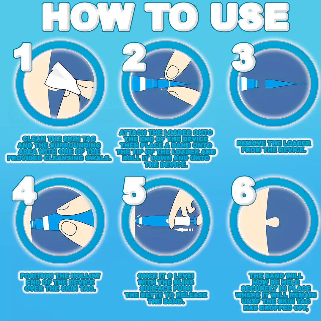 Painless Skin Tag Remover