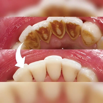 Professional Dental Scaler