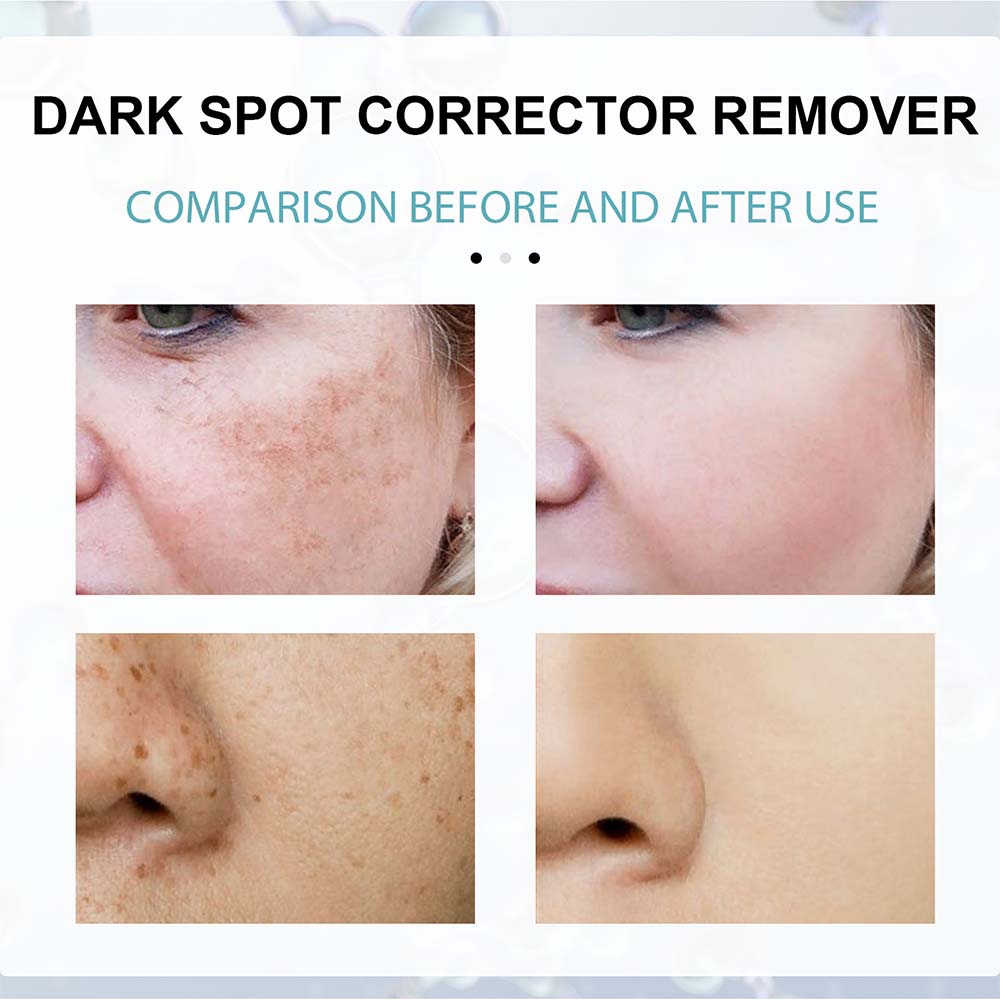 Anti-Dark Spot Skin Care Lightens Pigmentation Spots