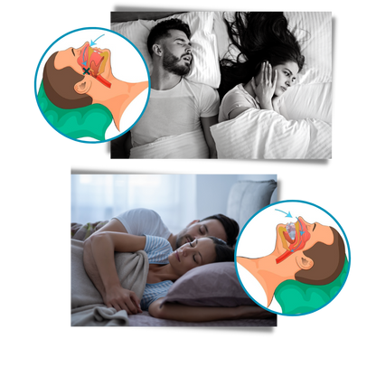 Advanced anti-snoring device