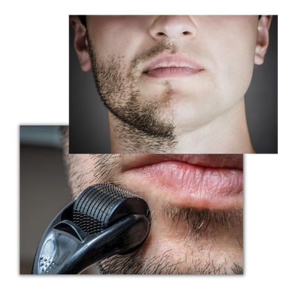 Dermal Roller For Hair And Beard Growth