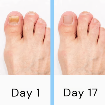 Nail Laser Fungus Device