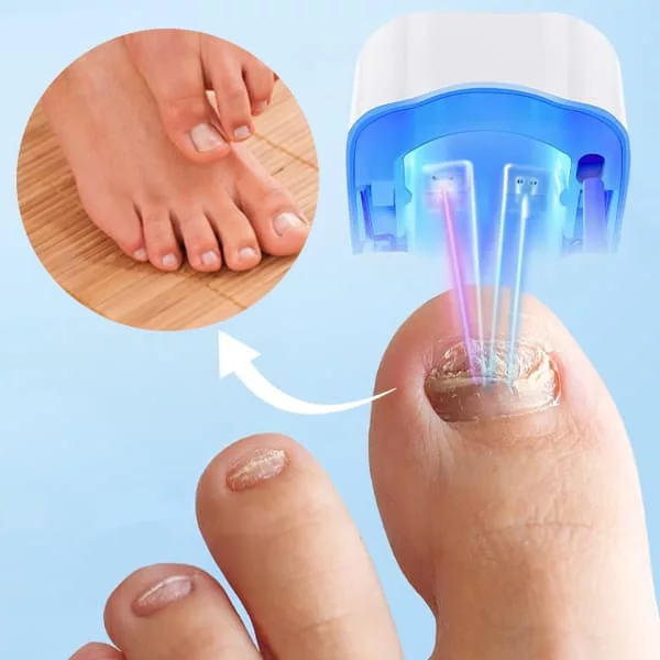 Nail Fungus Cleaning Laser Device