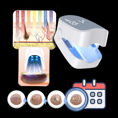 Painless Nail Fungus Laser